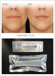 Dermal Filler 